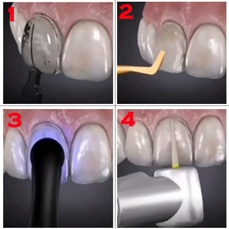 Dentals Mould For Composite Re - Teeth Whitening Moulds 评论和价格